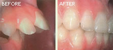 ortho-teeth-before-after